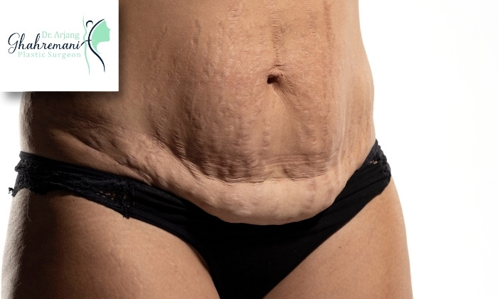 مدت زمان دوره نقاهت بعد از لیپوساکشن مدت زمان دوره نقاهت بعد از لیپوساکشن